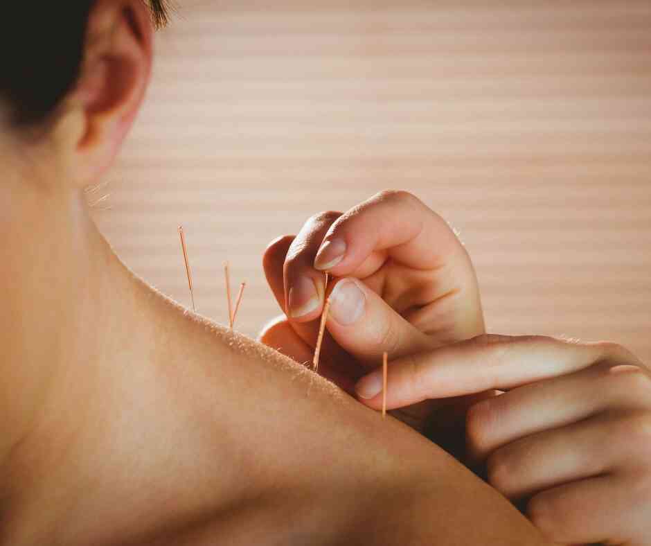 Akupunktura