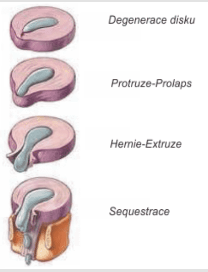 Poškození meziobratlové ploténky